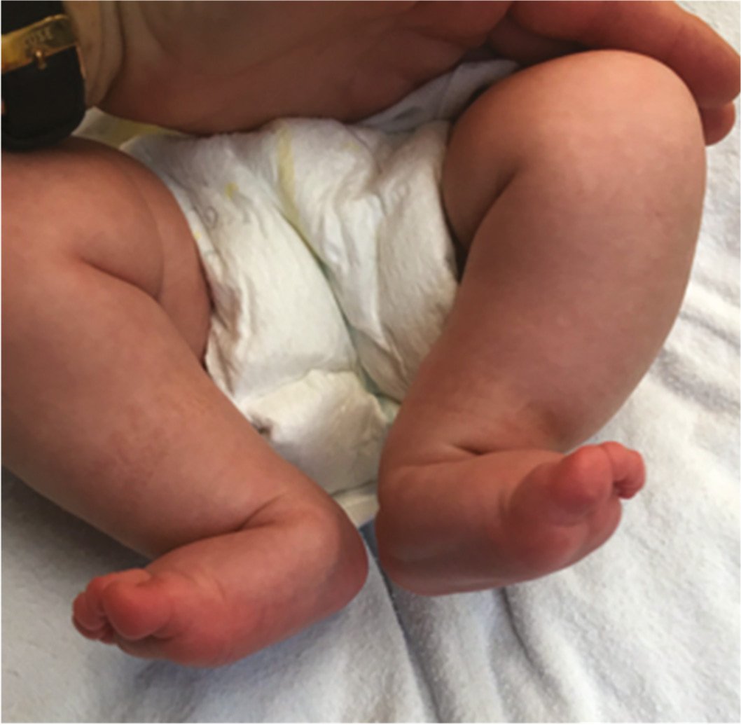 الكاحل العمودي الخلقي - Congenital Vertical Talus