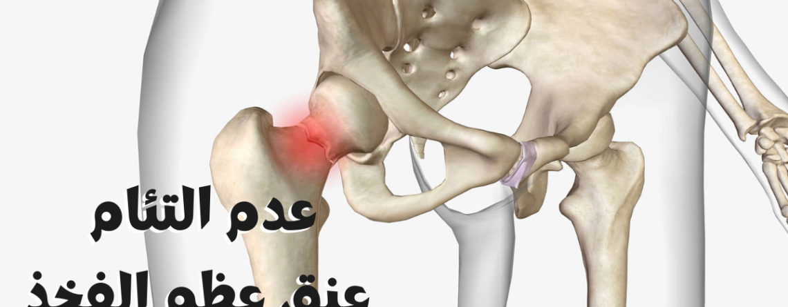 عدم التئام عنق عظم الفخذ