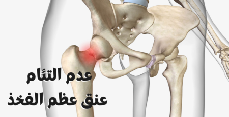 عدم التئام عنق عظم الفخذ