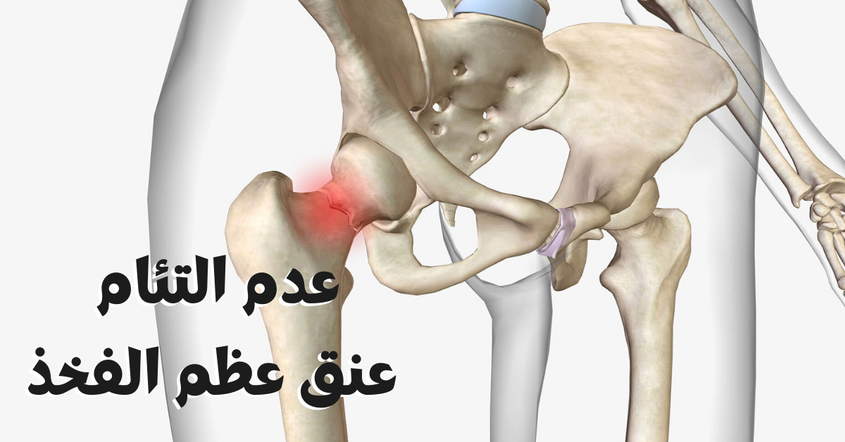عدم التئام عنق عظم الفخذ