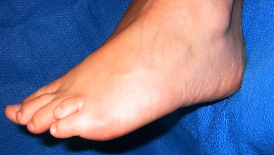 قصر أصابع القدم (قصر المشط) – Brachymetatarsia