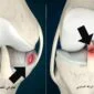 قطع الرباط الصليبي في حالات قطع الغضروف الهلالي