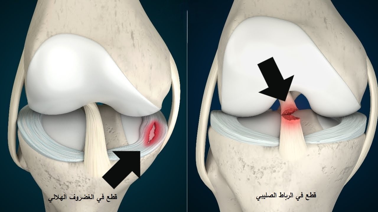 قطع الرباط الصليبي في حالات قطع الغضروف الهلالي