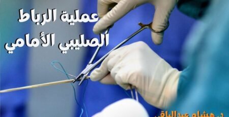 عملية الرباط الصليبي الأمامي