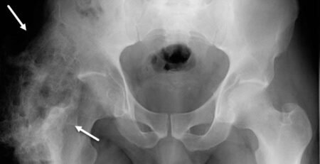 Heteroptopic Ossification