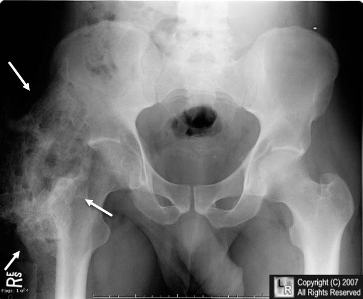 Heteroptopic Ossification