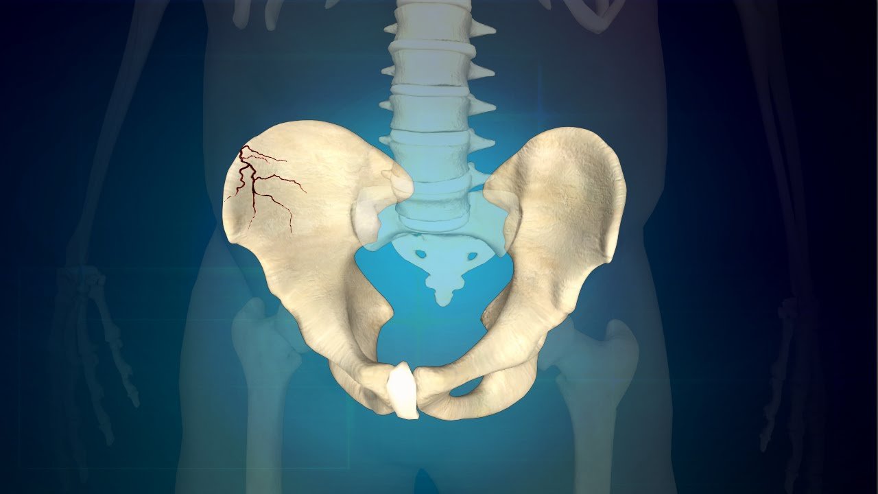 كسور الحوض - pelvic fractures