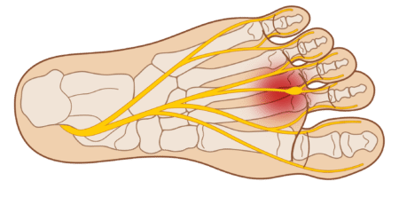 Morton neurom