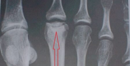 Freiberg’s Disease