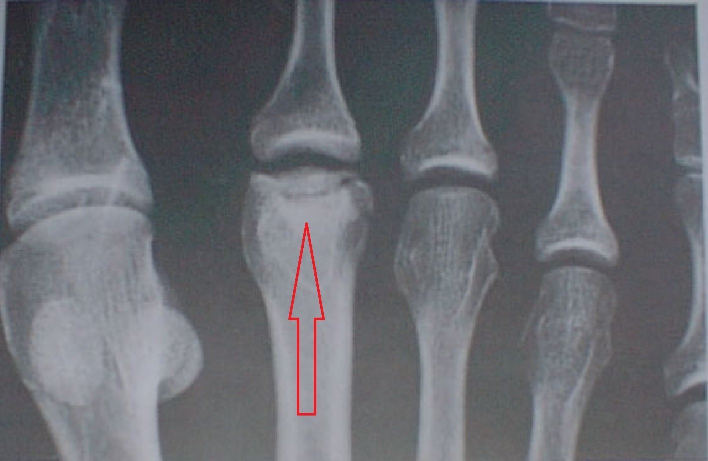 Freiberg’s Disease