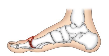 Hallux rigidus