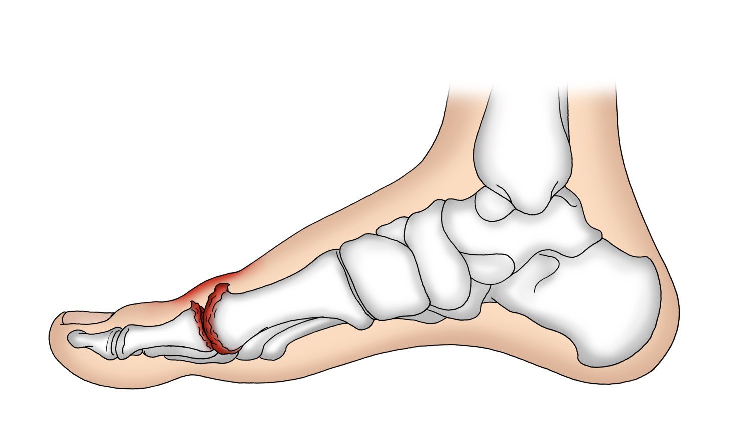 Hallux rigidus