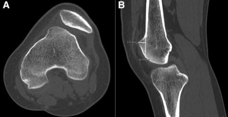 ct scan knee