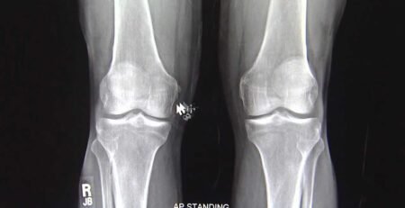 x ray knee