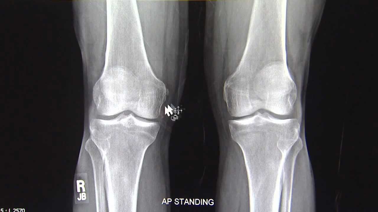 x ray knee