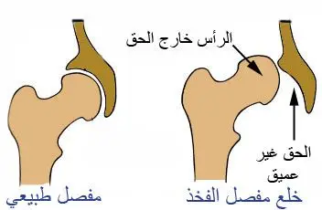 خلع مفصل الفخذ الولادي