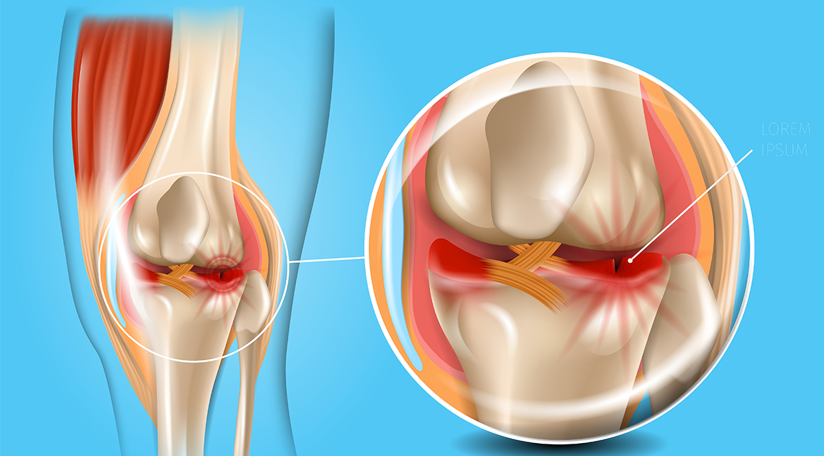 تمزق الغضروف الهلالي أحد اضرار تأخر عملية الرباط الصليبي