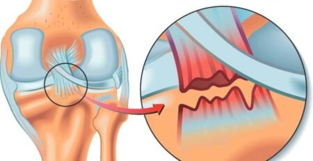 علاج الرباط الصليبي الخلفي​