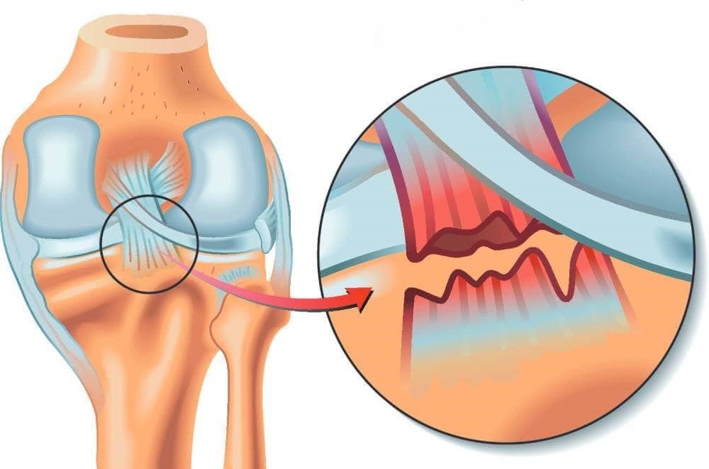 علاج الرباط الصليبي الخلفي​