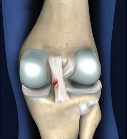 تمزق (قطع جزئي ) في الرباط الصليبي الخلفي