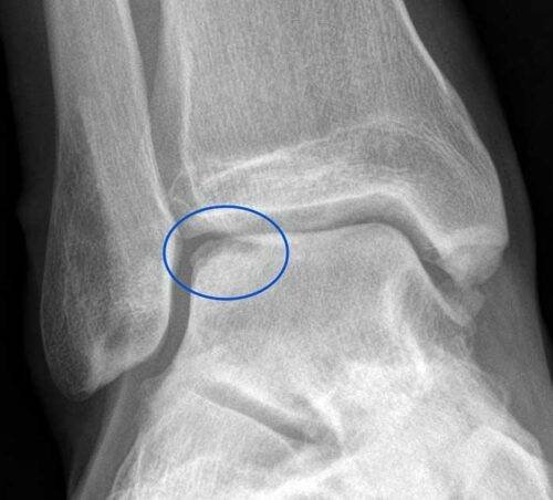 آفة الكاحل العظمية الغضروفية أحد دواع استخدام منظار الكاحل