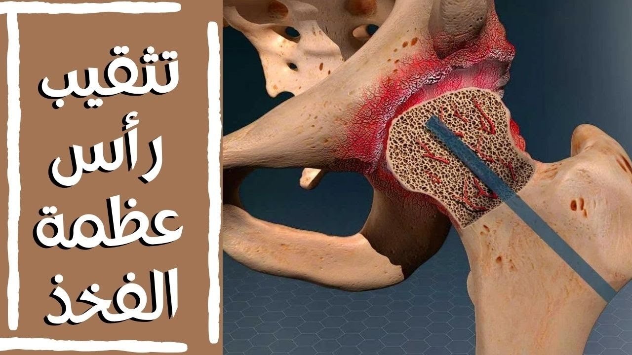 فيديو عن تثقيب رأس عظمة الفخذ