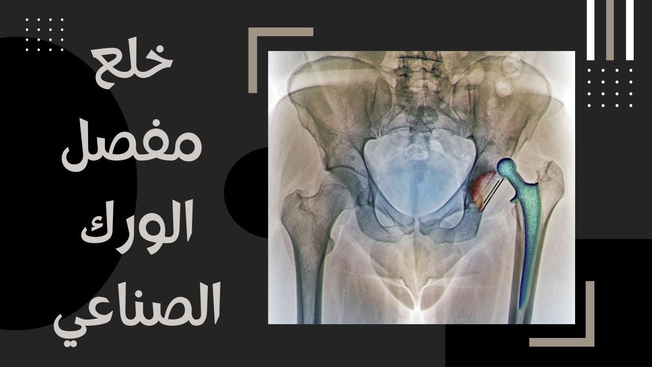 خلع مفصل الفخذ الصناعي
