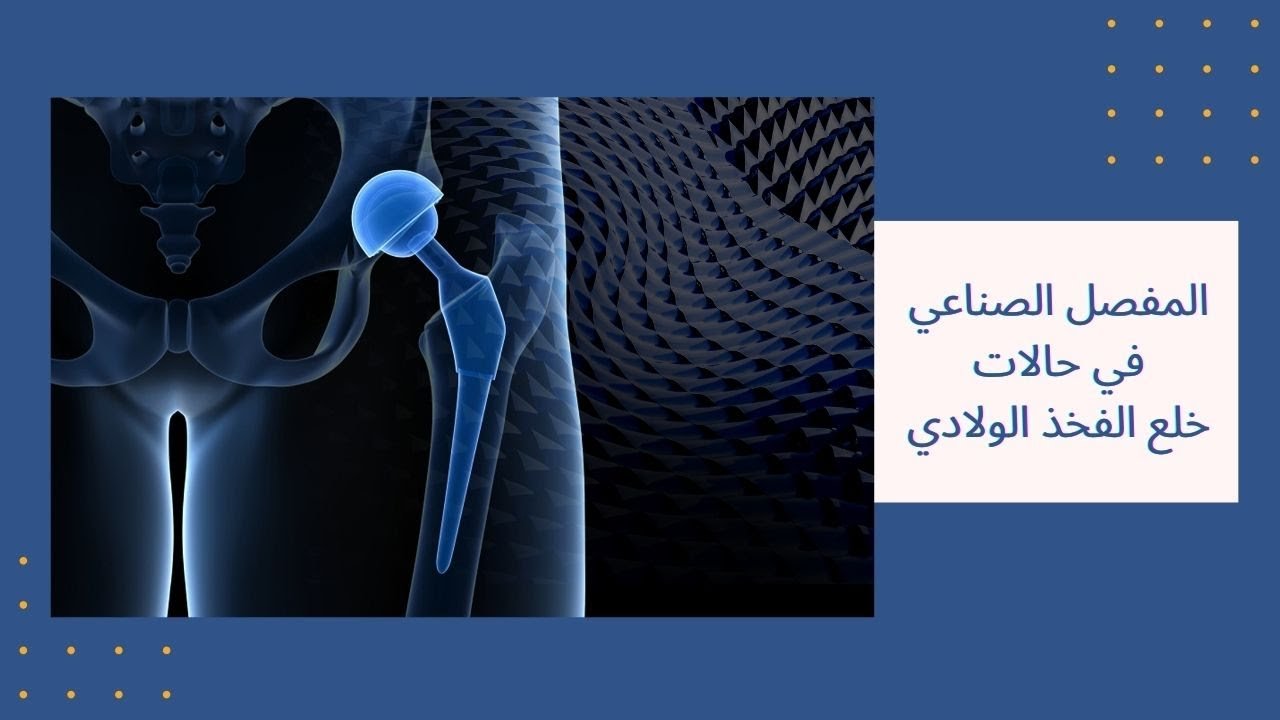 فيديو عن المفصل الصناعي فى حالات خلع الفخذ الولادي