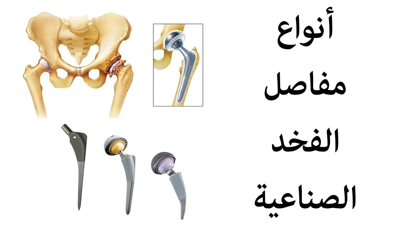 فيديو عن انواع مفاصل الفخذ الصناعية