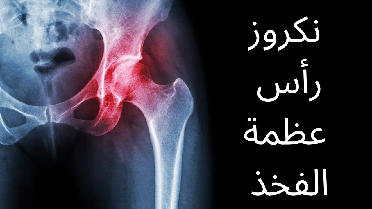 فيديو عن نكروز و نخر رأس عظمة الفخذ
