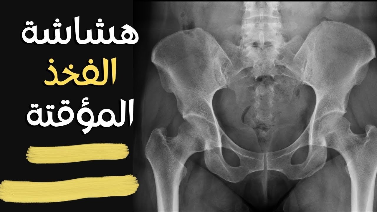 فيديو عن هشاشة عظام الفخذ المؤقتة