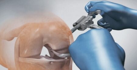 أحدث الطرق الجراحية لعلاج قطع الرباط الصليبي الامامي في 2025