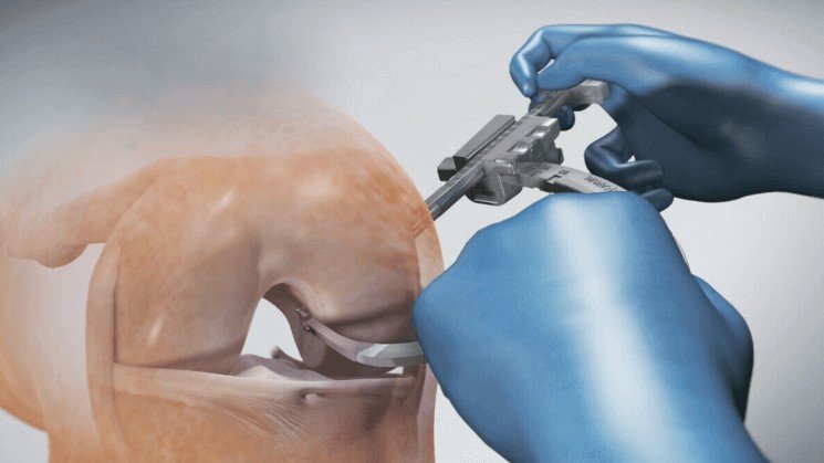 أحدث الطرق الجراحية لعلاج قطع الرباط الصليبي الامامي في 2025