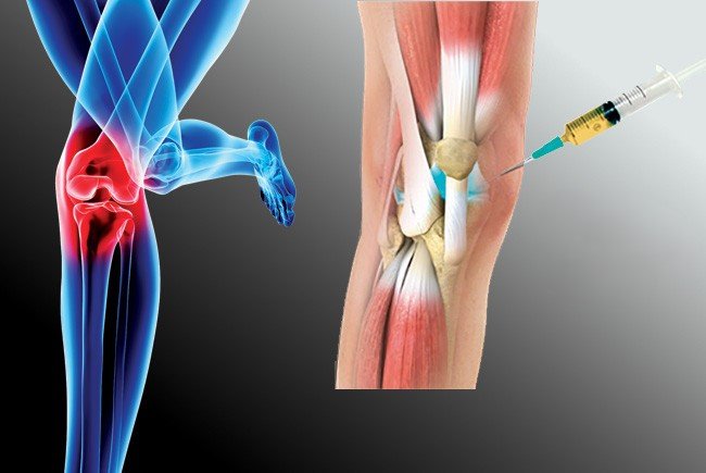 تحسين وظائف المفصل أحد فوائد حقن البلازما