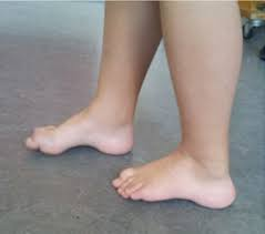 تشوه القدم الكهفية في الاطفال