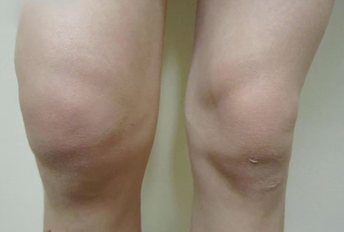 تورم مفصل الركبة بعد اصابة الرباط الصليبي