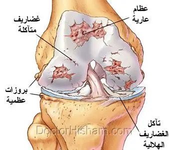 خشونة الركبة (تآكل غضاريف الركبة)
