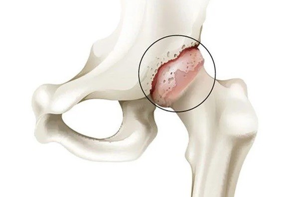 خشونة مفصل الفخذ