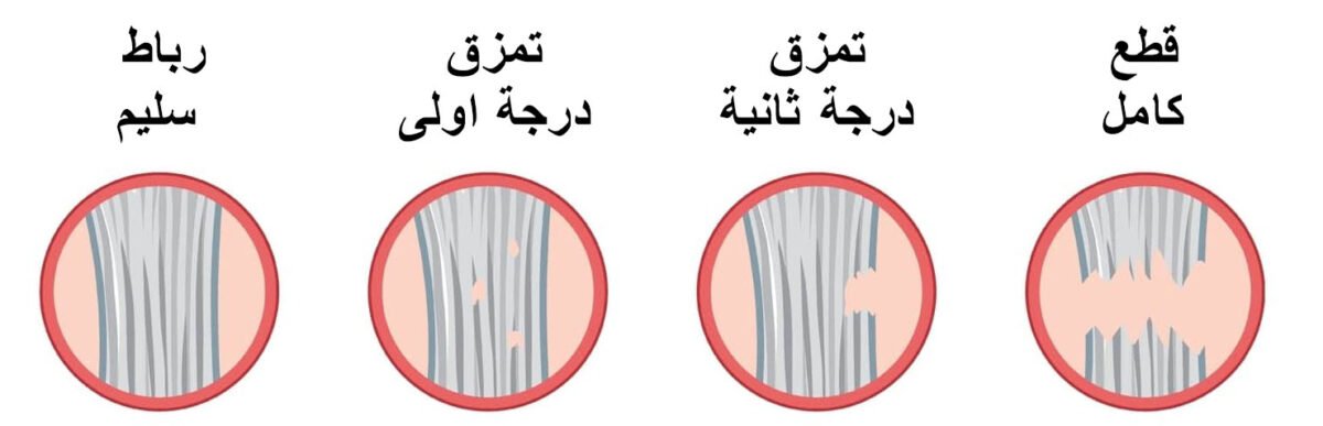 الفرق بين قطع والتواء الرباط الصليبي