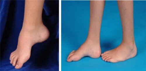 شكل تشوه القدم الكهفية