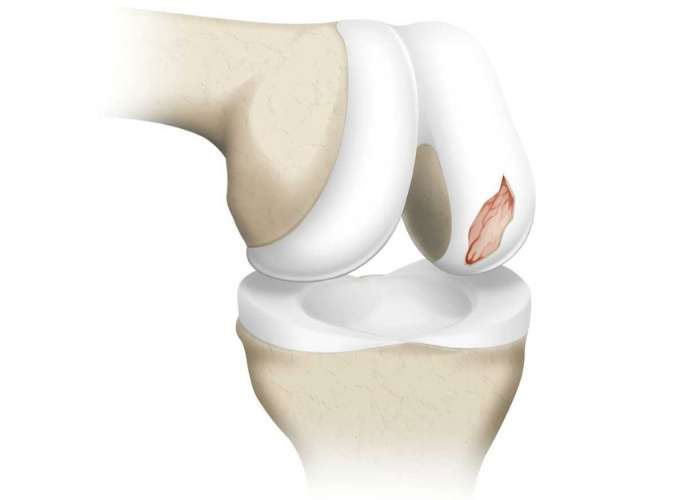 صورة توضح اصابة في الغضروف المفصلي Articular Cartilage
