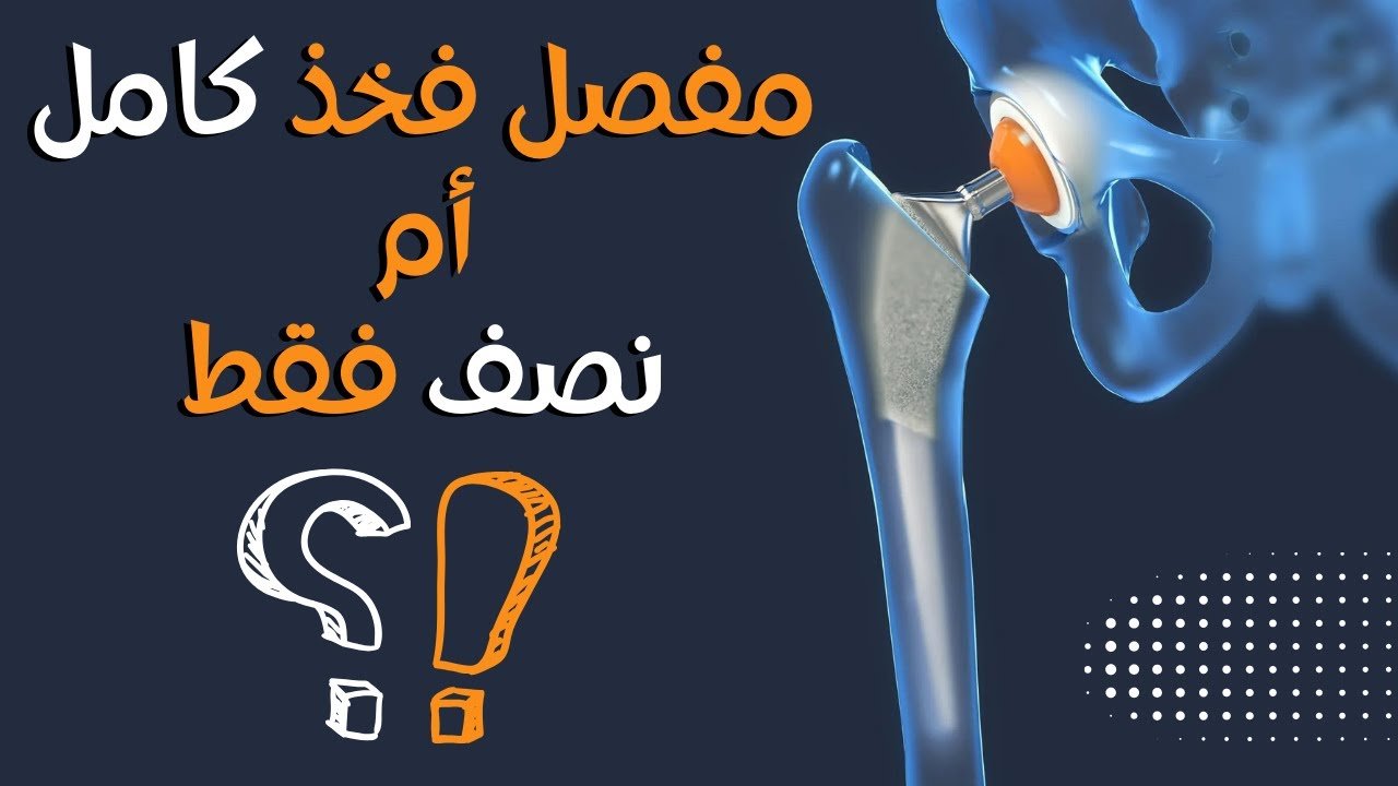 فيديو عملية تركيب مفصل صناعي للفخذ