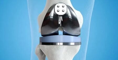 عملية تغيير مفصل الركبة أحدث التقنيات ونسبة الشفاء 2025