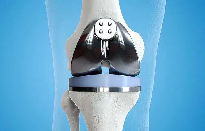 عملية تغيير مفصل الركبة أحدث التقنيات ونسبة الشفاء 2025