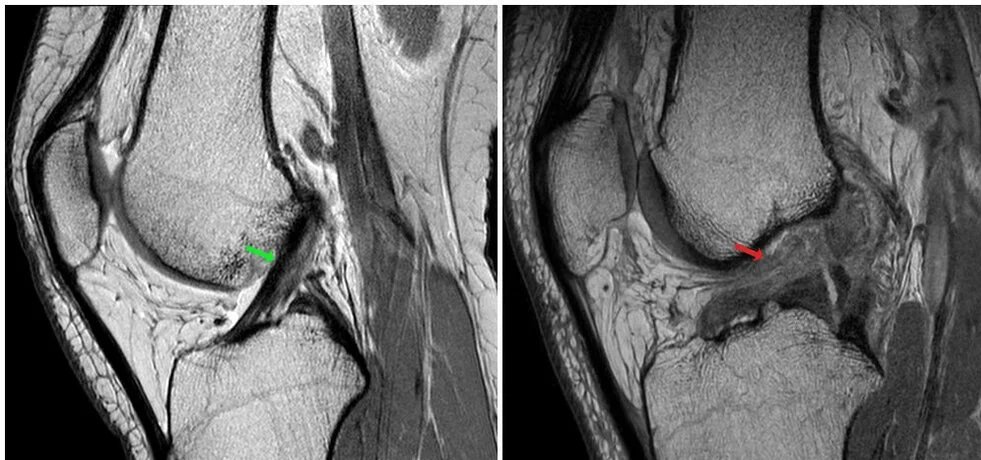 قطع الرباط الصليبي الامامي كما يظهر في الرنين المغناطيسي