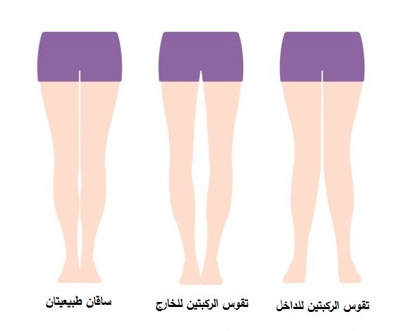 أنواع تقوس الساقين 