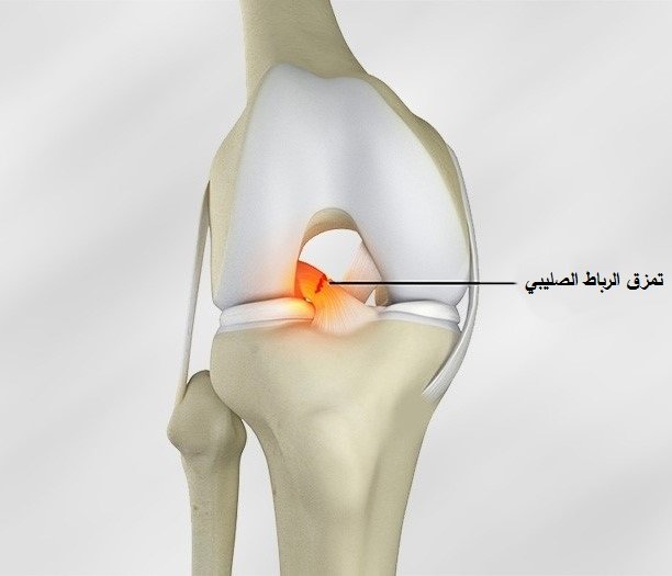 إصابة الرباط الصليبي الامامي أحد أشهر اصابات الملاعب