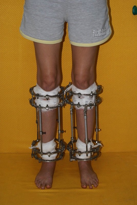 المثبت الخارجي إليزاروف أحد الطرق الجراحية لعلاج تقوس الساقين