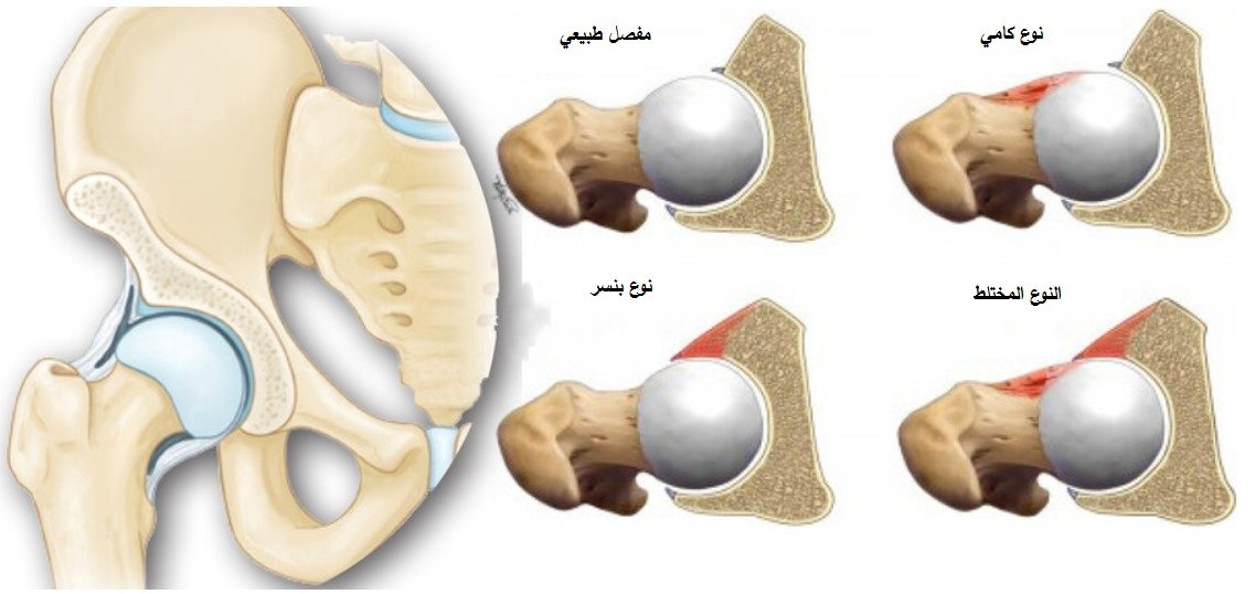 انواع انحشار مفصل الفخذ FAI