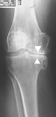 تقوس الساقين أحد اسباب خشونة الركبة (تآكل غضروف الركبة)